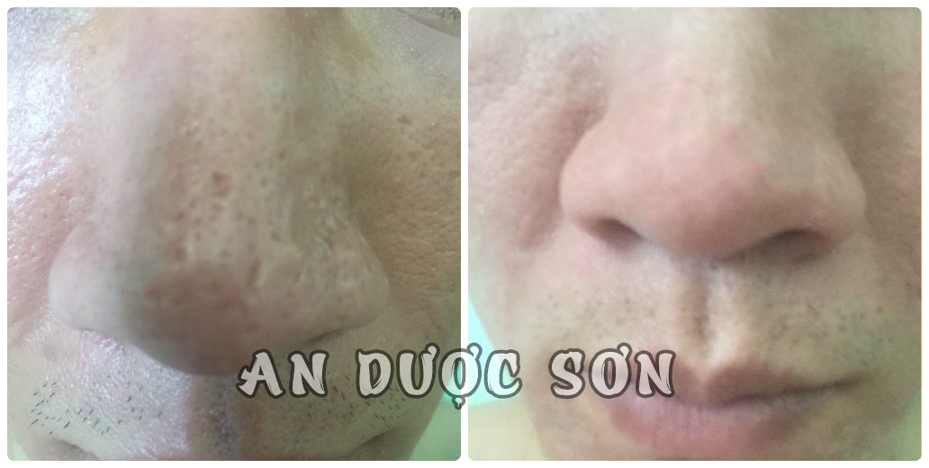 Combo Serum ngừa mụn thâm sẹo rỗ An Dược Sơn 30ml + Bột rửa mặt an dược sơn