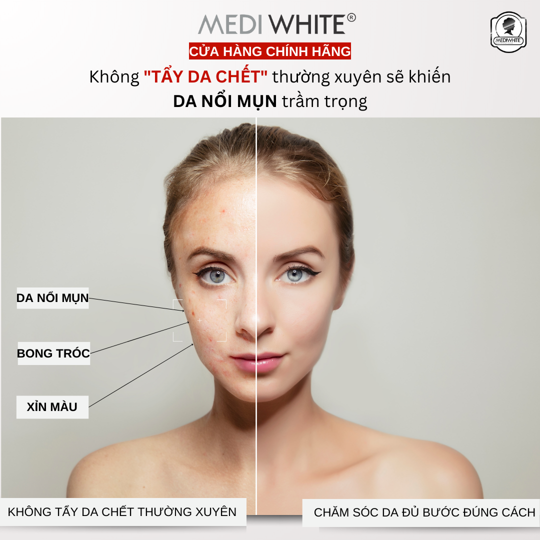 Kem Tẩy Tế Bào chết Medi White Dành Cho Da Nhờn Mụn Giúp Loại Bỏ Tế Bào Da Chết Làm Sáng Da