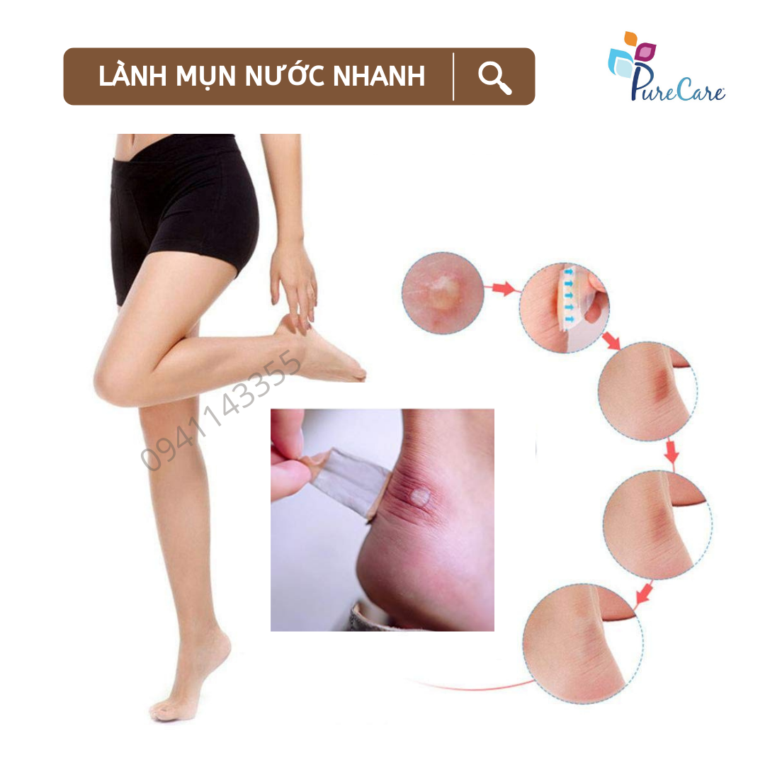 Miếng băng dán giảm mụn nước, vết chai, vết phỏng, phỏng pô, BỘ 1 CÁI