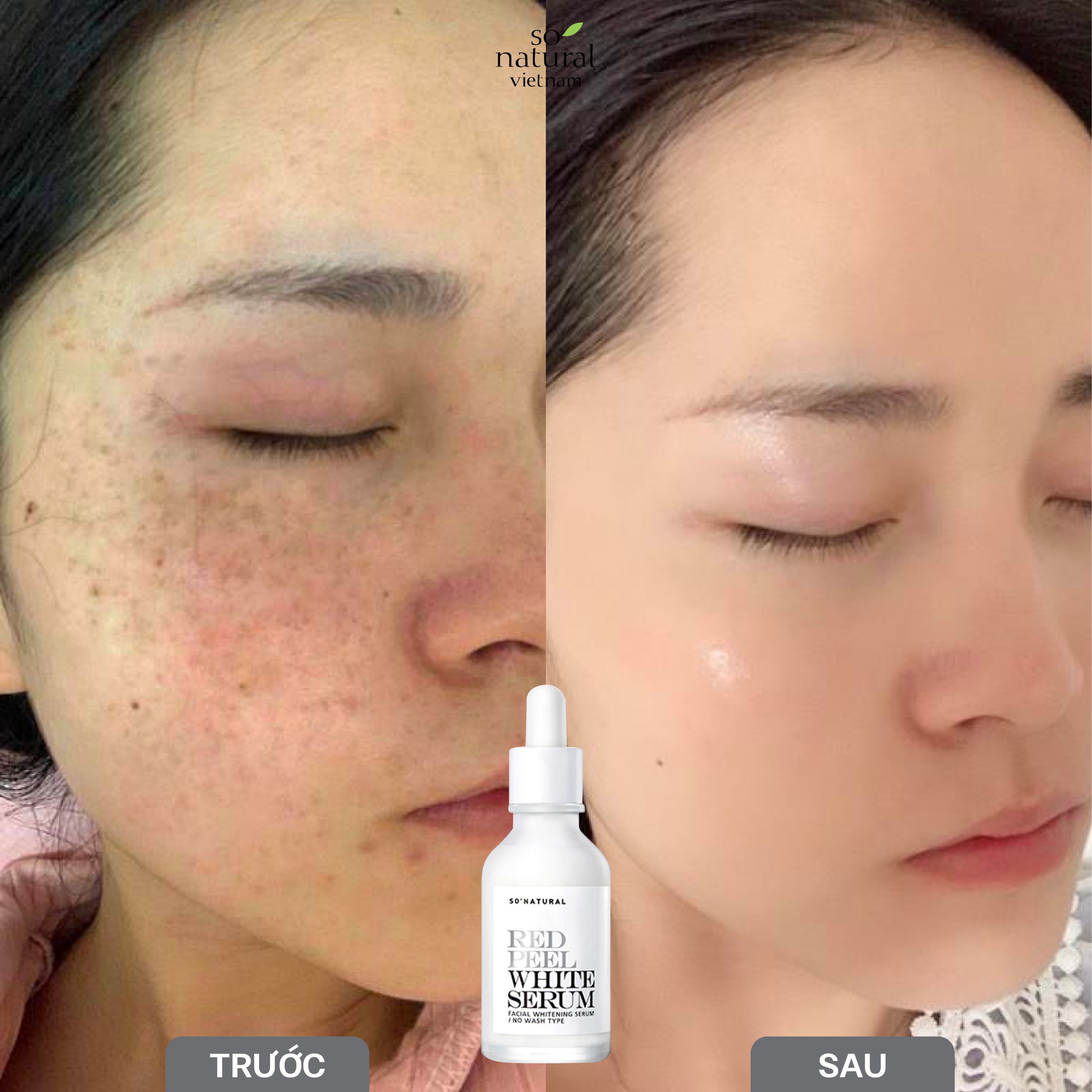 Serum peel da Red Peel WHITE So Natural ức chế mờ nám hiệu quả