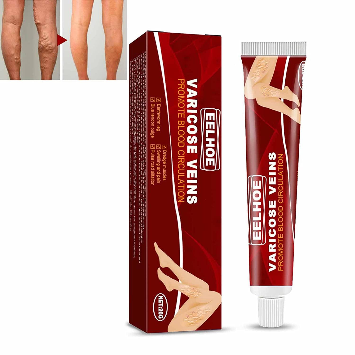 Kem tĩnh mạch tĩnh mạch, kem tĩnh mạch tĩnh mạch so với tĩnh mạch nhện, kem tĩnh mạch tĩnh mạch so với tĩnh mạch nhện, thuốc mỡ chăm sóc chân, 20G