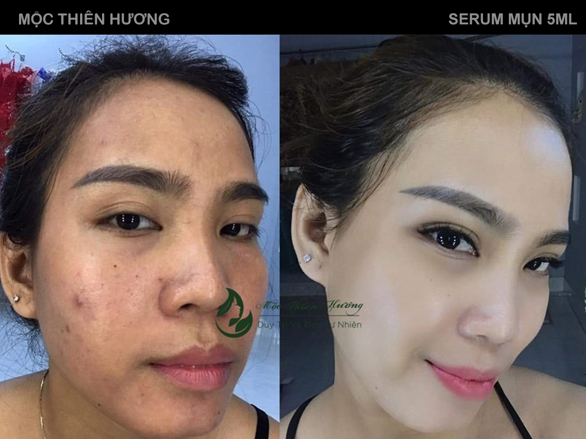 Serum 14 Ngày Hết Mụn Sạch Thâm Không Bong Tróc Không Sưng Đỏ - Mộc Thiên Hương