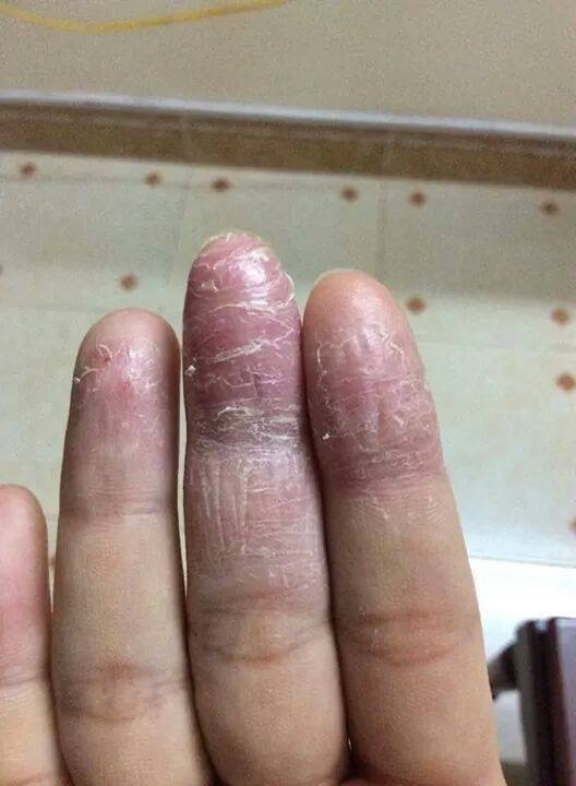 Thảo dược bôi nấm ngứa, tổ đỉa, hắc lào, lang ben, vảy nến, á sừng, zona các vấn đề về da_1 hộp 20 gói