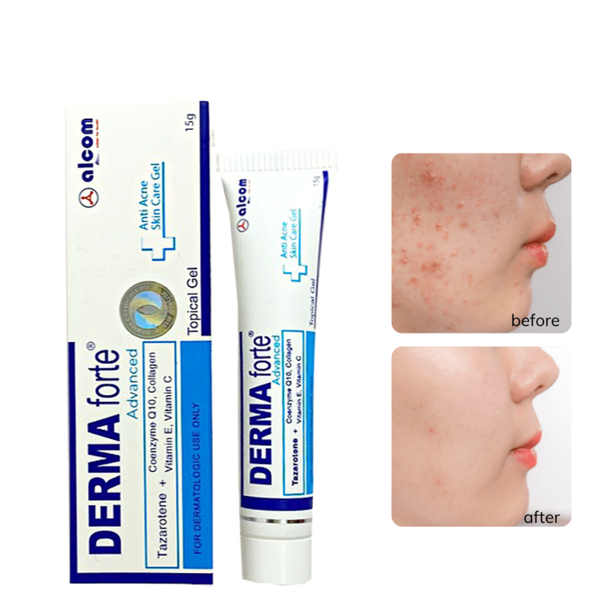 Derma Forte Gel 15g - Adavanced, Giảm Mụn Trứng Cá, Mờ Sẹo, Dưỡng Da