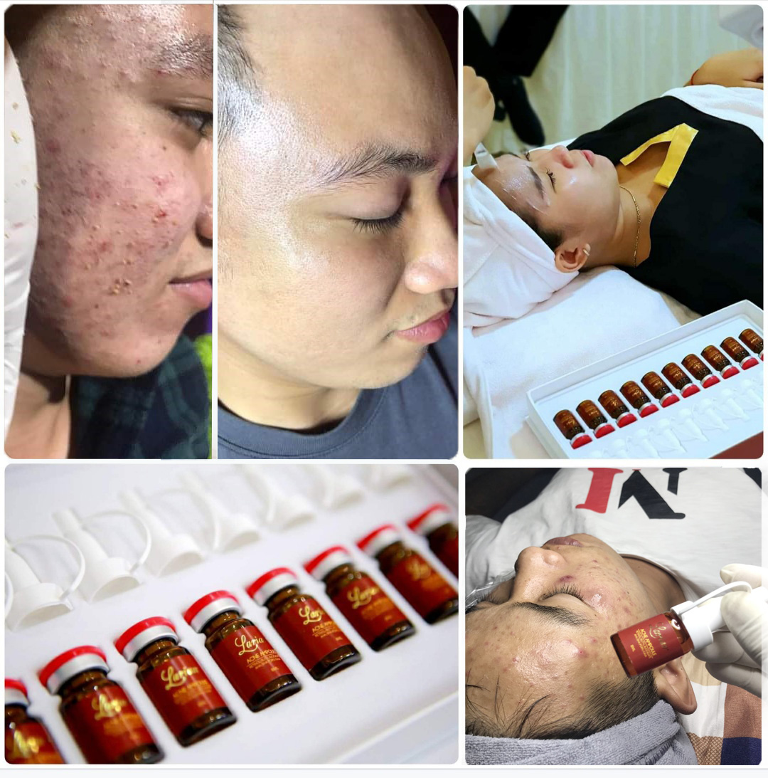 Combo 5 lọ Tế bào gốc Acne Ampoule Larian (làm giảm mụn sưng viêm, làm đầy sẹo rỗ, xoá mờ vết thâm)