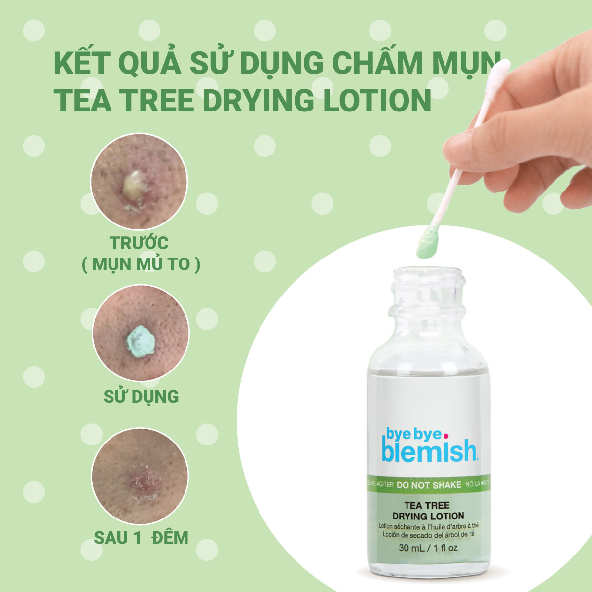 Chấm mụn Tràm Trà giảm mụn nhanh sau 1 đêm dành cho da mụn sưng viêm Bye Bye Blemish Tea Tree Drying Lotion 30ml