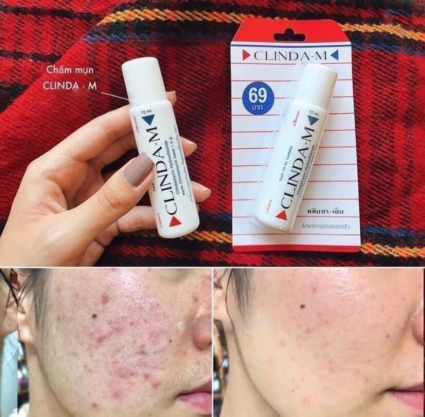 Gel mụn Clinda-M Thái Lan 15ml đẩy nhân mụn lên nhanh , giảm mụn
