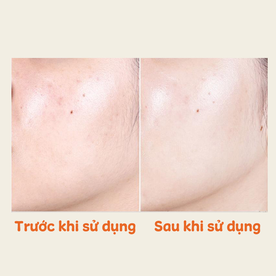 Tinh Chất Trắng Da Hỗ Trợ Trị Thâm Nám PURE C+