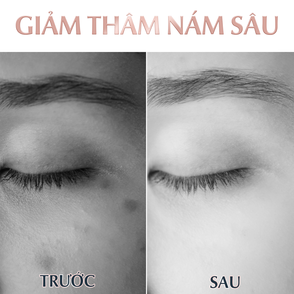 Tinh Chất Giảm Thâm Nám Chuyên Biệt Cho Da Nhờn & Hỗn Hợp Eucerin Spotless Britening Crystal Booster Serum 30ml