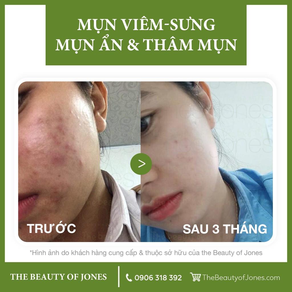 Combo làm sạch và cấp ẩm dành cho da dầu mụn The Beauty of Jones