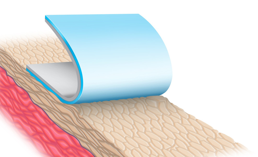 Miếng dán Silicone ngăn ngừa và hỗ trợ điều trị sẹo lồi - Advasil Conform