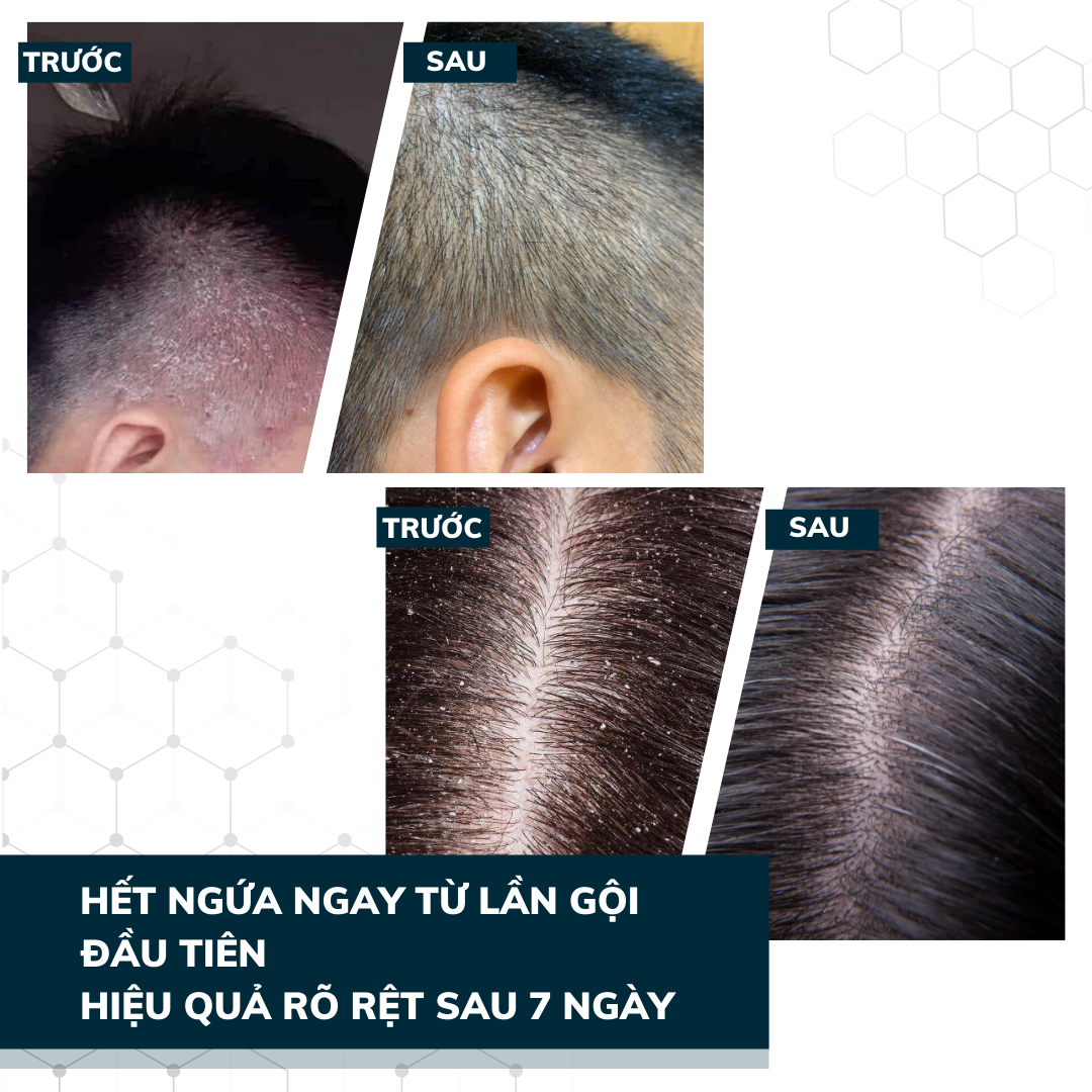 Dego Pharma - Dầu gội sạch vảy gàu mảng trắng, hết ngứa chiết xuất thiên nhiên từ vỏ cây Zizyphus, sản xuất theo tiêu chuẩn và dưới sự giám sát của công ty dược phẩm Châu Âu