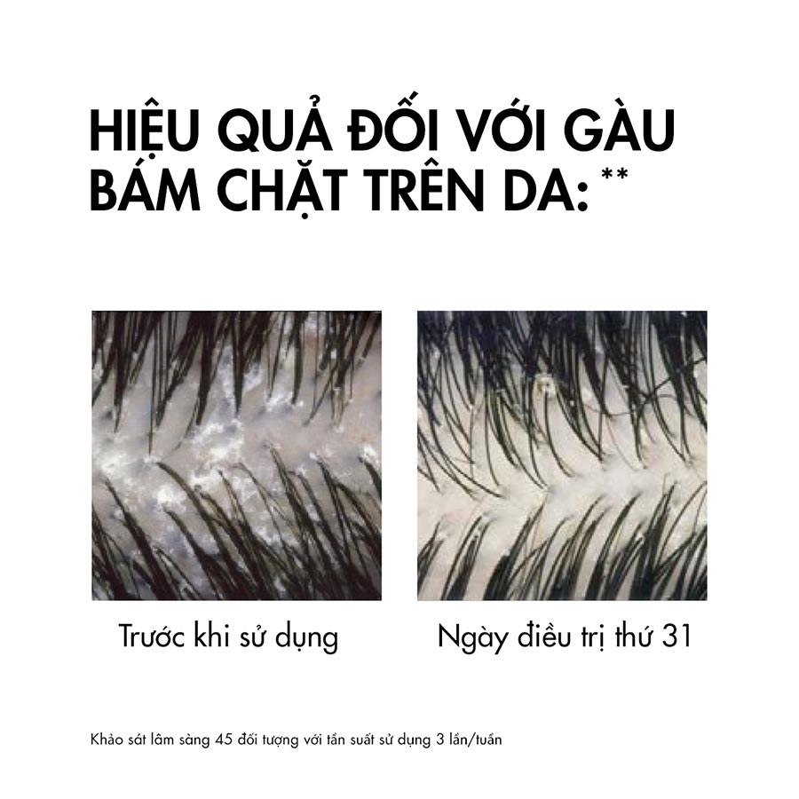 Dầu gội sạch gàu cho da đầu dầu, ngứa Vichy Dercos Anti Dandruff 200ml
