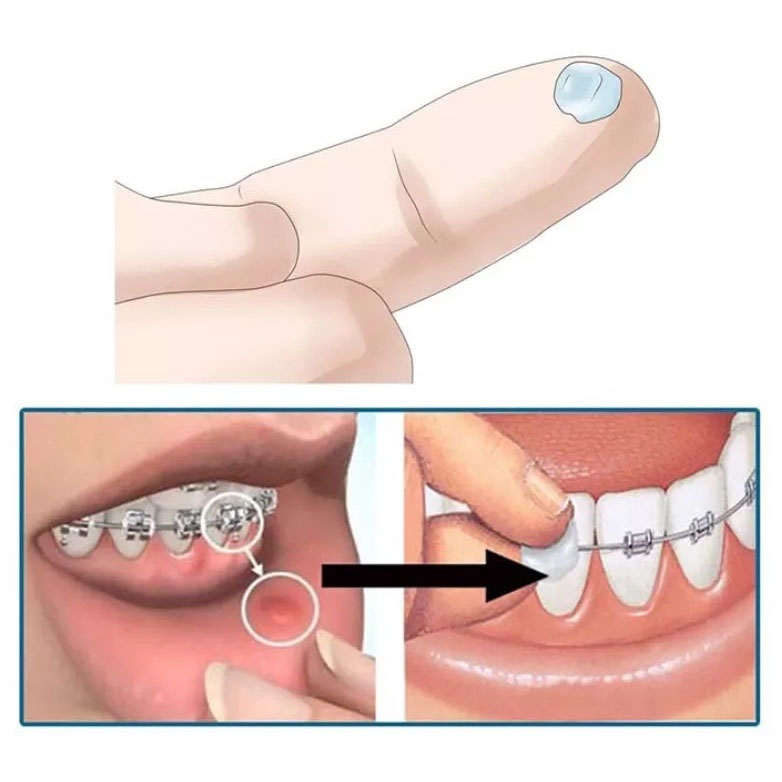 Hình ảnh Sáp nha khoa giảm đau khi niềng răng, chỉnh nha - Vitis Orthodontic Wax (Vỉ 2 hộp)