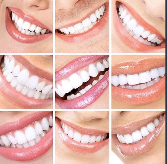 Nha Khoa Nhật Nguyệt SG - Tẩy Trắng Răng