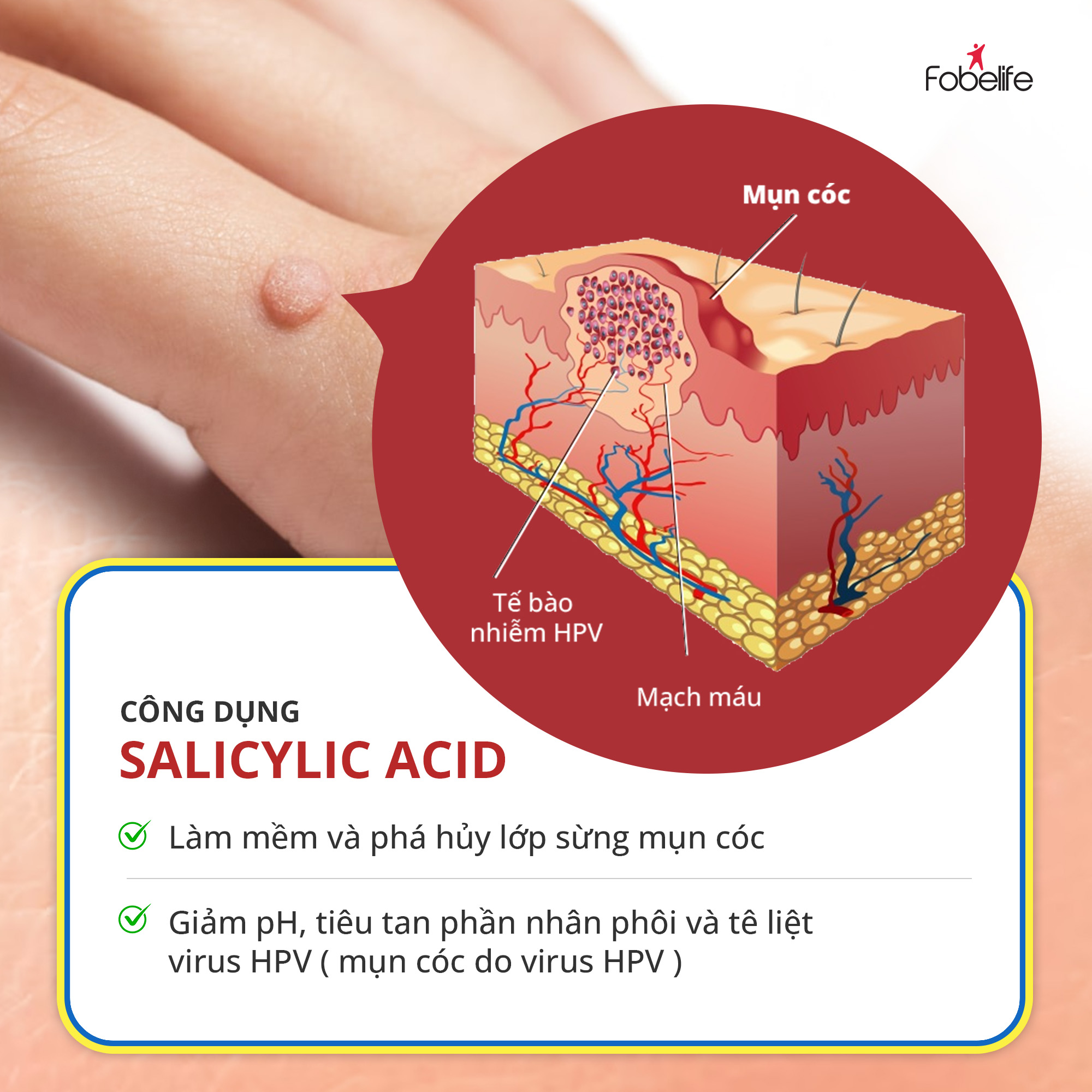 Miếng Dán Mụn Cóc Loại Bỏ Mụn Cóc Tại Nhà An Toàn Corn Removal Plaster ( Hộp 6 miếng )