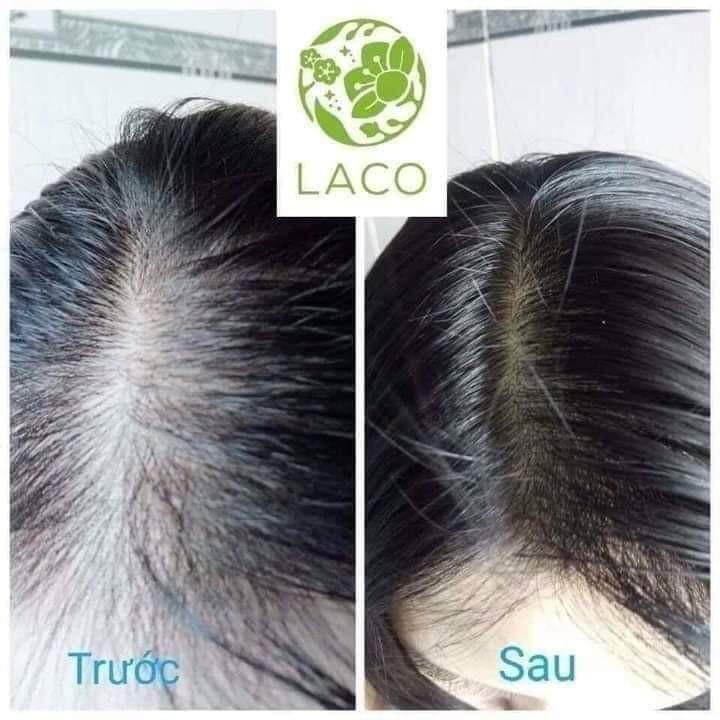 Full bộ 4 sản phẩm Gội xả serum dưỡng tóc amla detox