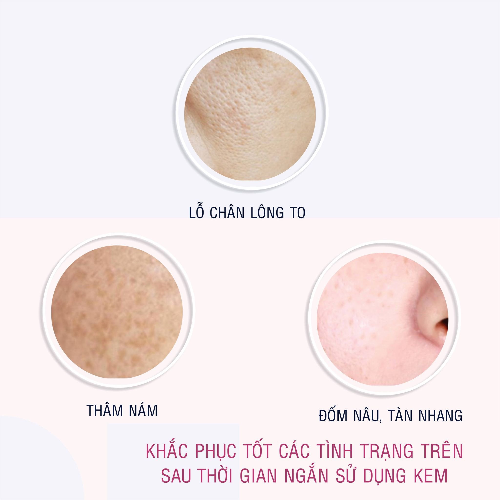 Kem Hỗ Trợ Giảm Thâm Nám Và Tàn Nhang Melasma-X 3D Whitening Clinic Cream