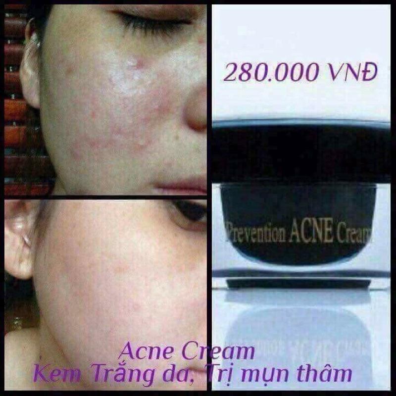 Kem Ngăn Ngừa Mụn Acne DR CELL 30g