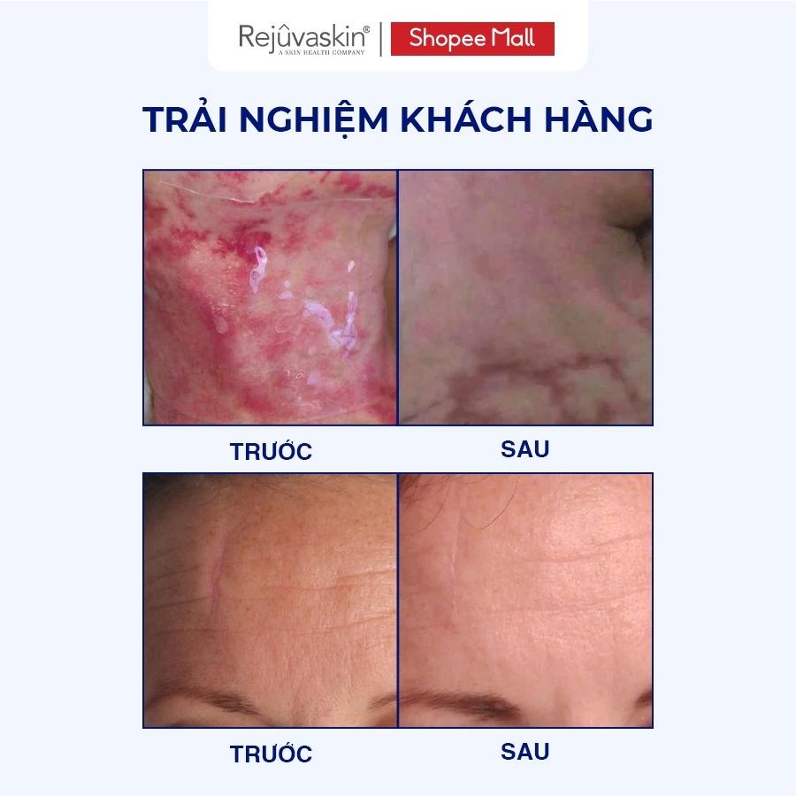 Miếng Dán Làm Xẹp Sẹo Lồi / Phì Đại, Ép Sẹp REJUVASKIN Scar FX