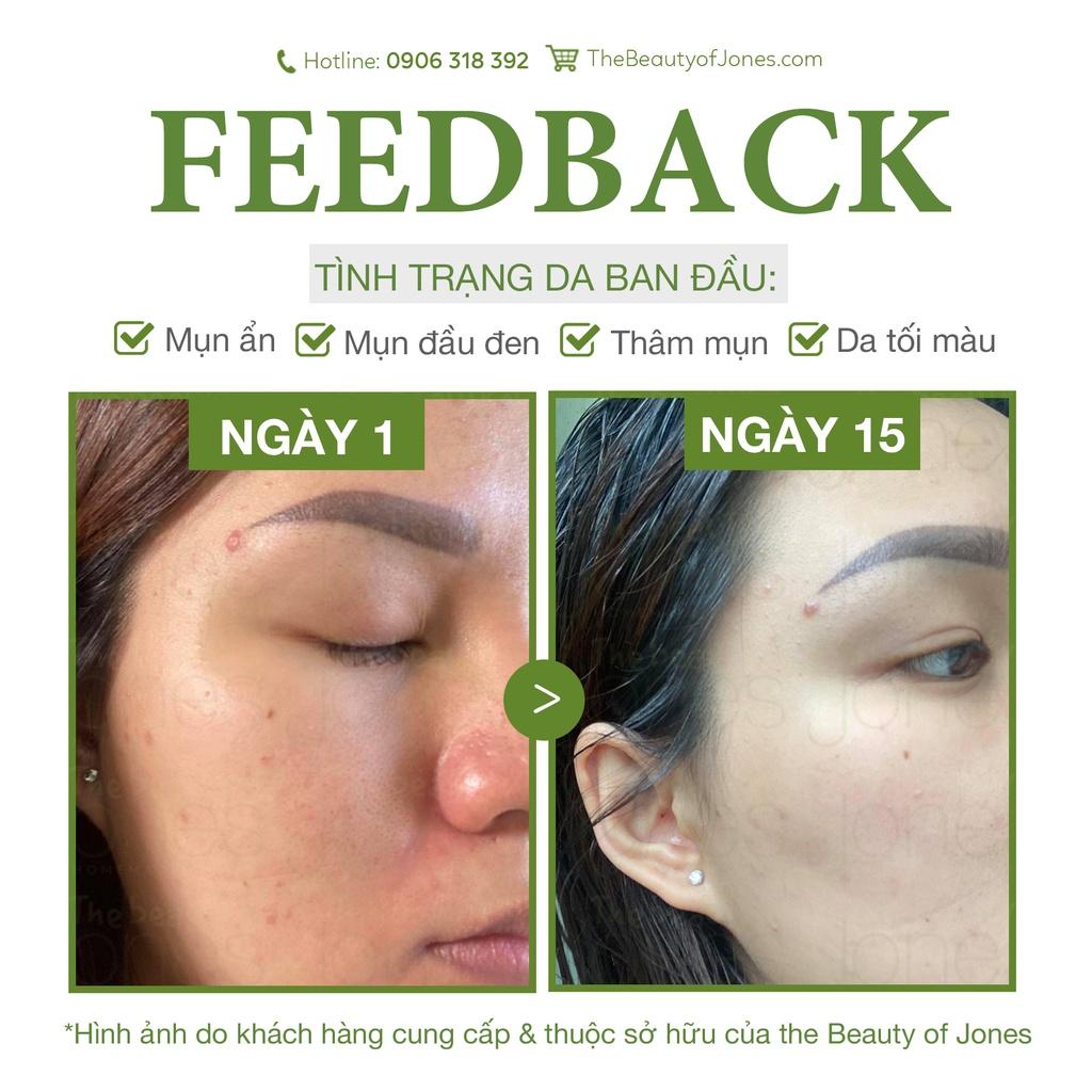 Mặt nạ than tre ngừa mụn an toàn cho mẹ bầu The Beauty of Jones 50gr