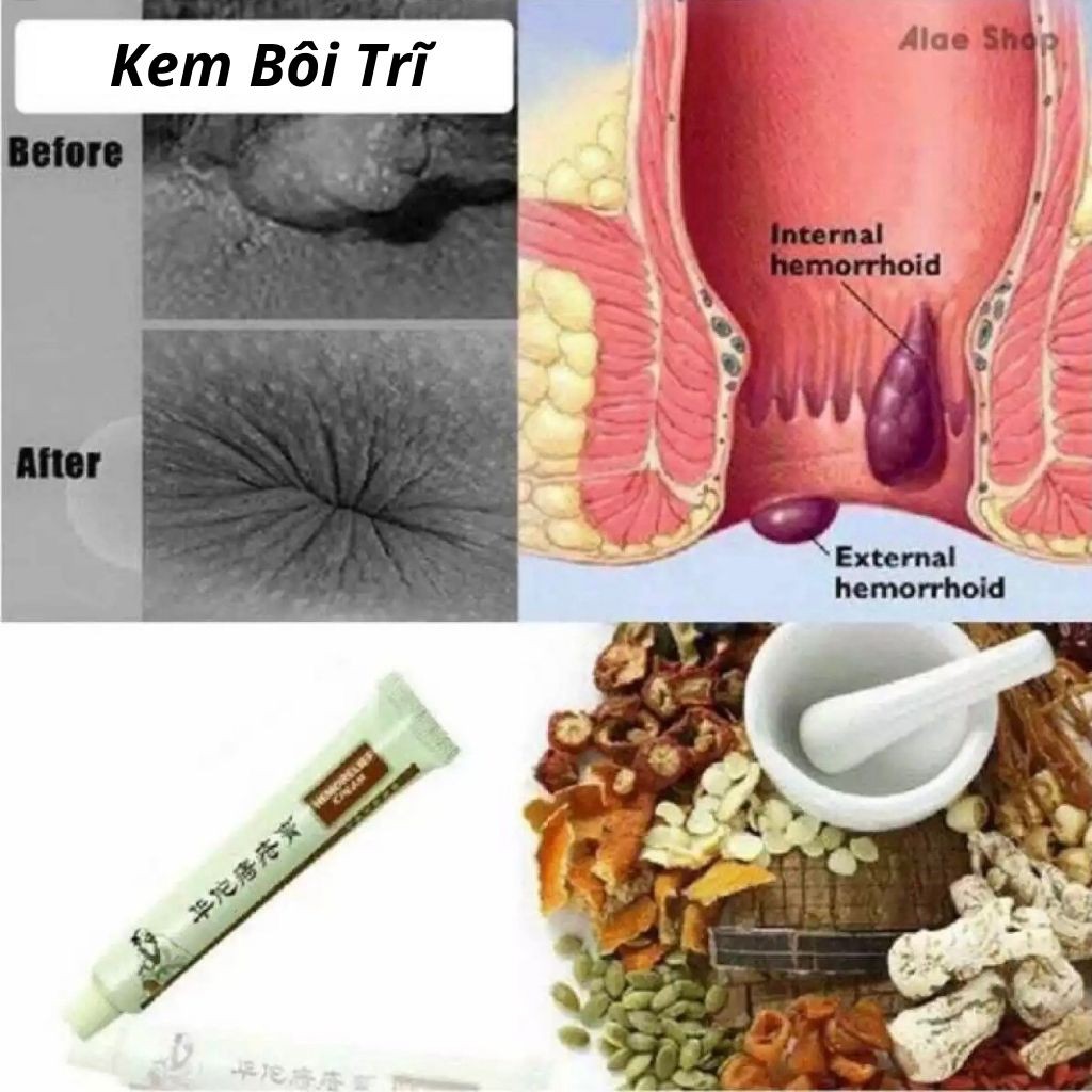 Kem Bôi Trĩ Nứt Kẽ Hậu Môn Thảo dượᴄ Authentic Hemorrhoids Chinese Herbal Cream Ointment 20g -