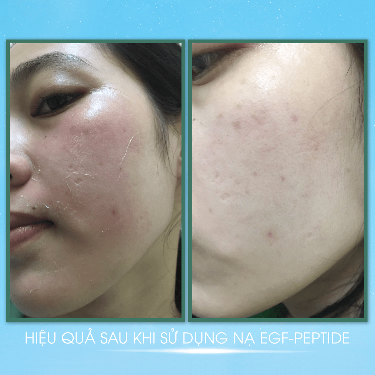 COMBO 10 Mặt Nạ Dạng Thạch MS EGF - Peptide Mask Giúp Dưỡng Ẩm, Mặt Nạ Thạch Phục Hồi Và Tái Tạo Da Giúp Da Săn Chắc (1 Miếng - 23g) - MỸ PHẨM MS COSMETIC