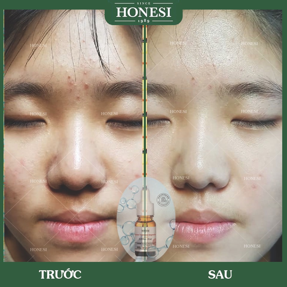 Sét Serum Giảm Mụn Nhanh Lành Tính HONESI Acne Treatment Ampoule (10ml x 5 lọ) - Hàn Quốc