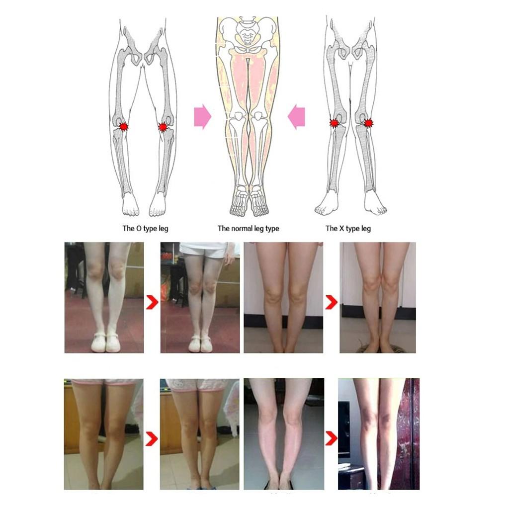 Đai Chỉnh Hình Chân Bị Cong Vòng Kiềng Cao Cấp