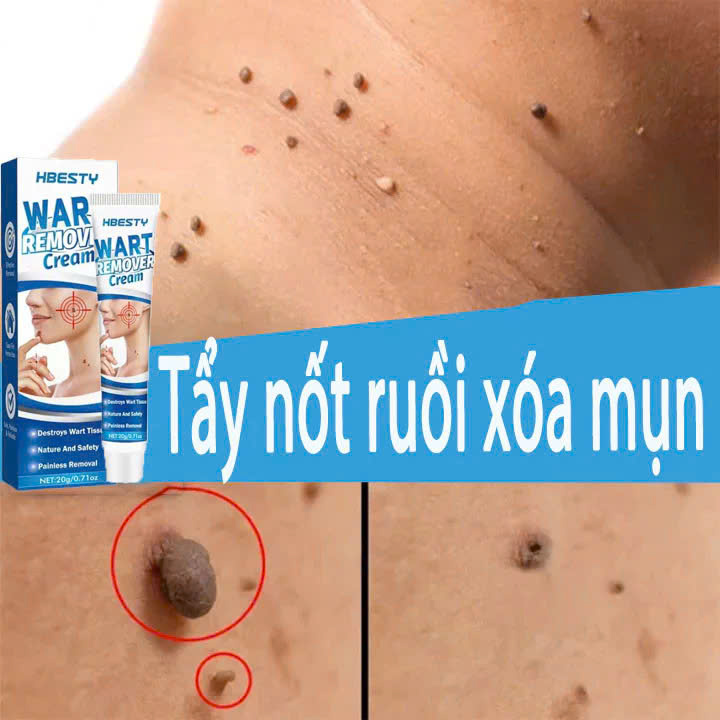 Serum Xóa Mụn Cóc, Mụn Thịt, Nốt Ruồi Hiệu Quả Cao – Thảo Dược Thiên Nhiên, Không Gây Sẹo đèn led