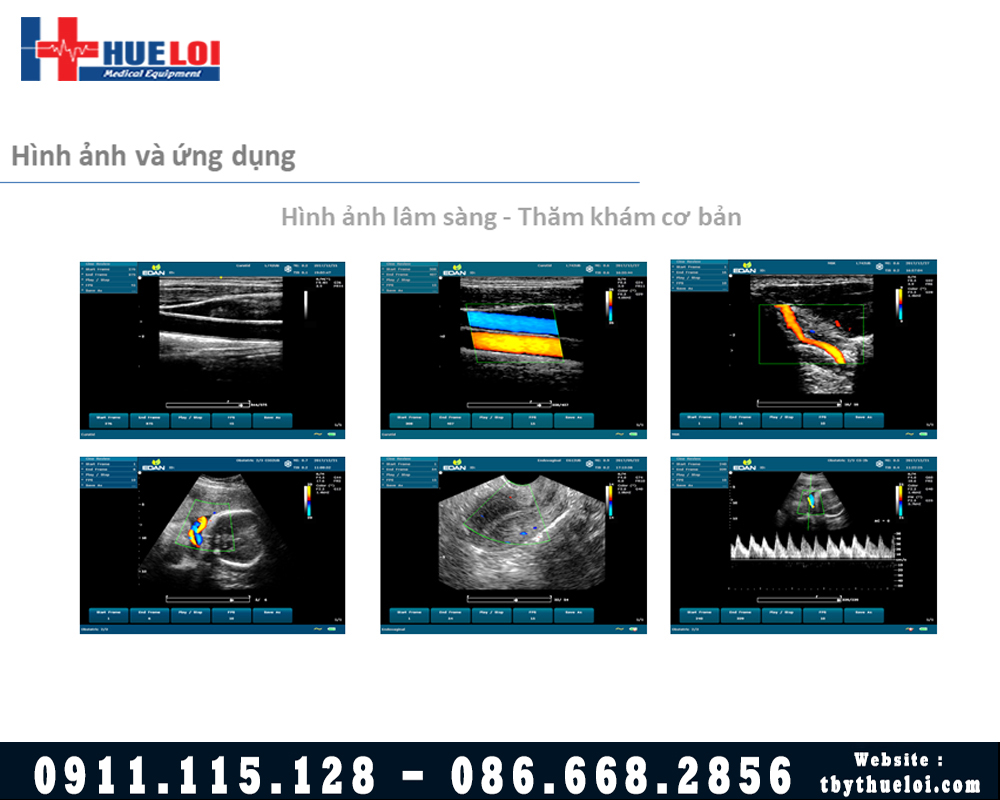 Máy Siêu Âm Xách Tay EDAN U60 - Hình Ảnh Sắc Nét Xứng Đáng Đầu Tư