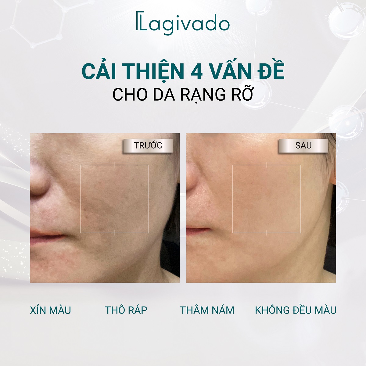 Kem dưỡng trắng da, mờ thâm nám, đốm nâu Lagivado High-L Revital Cream với Arbutin 2% - 10 g