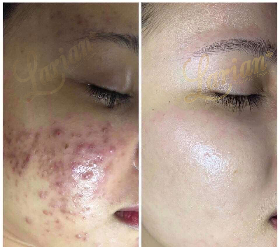 Tế bào gốc trị mụn Dna Cá Hồi Larian Acne Ampoupe dành cho Spa trong liệu trình trị liệu chuyên sâu cho da mụn