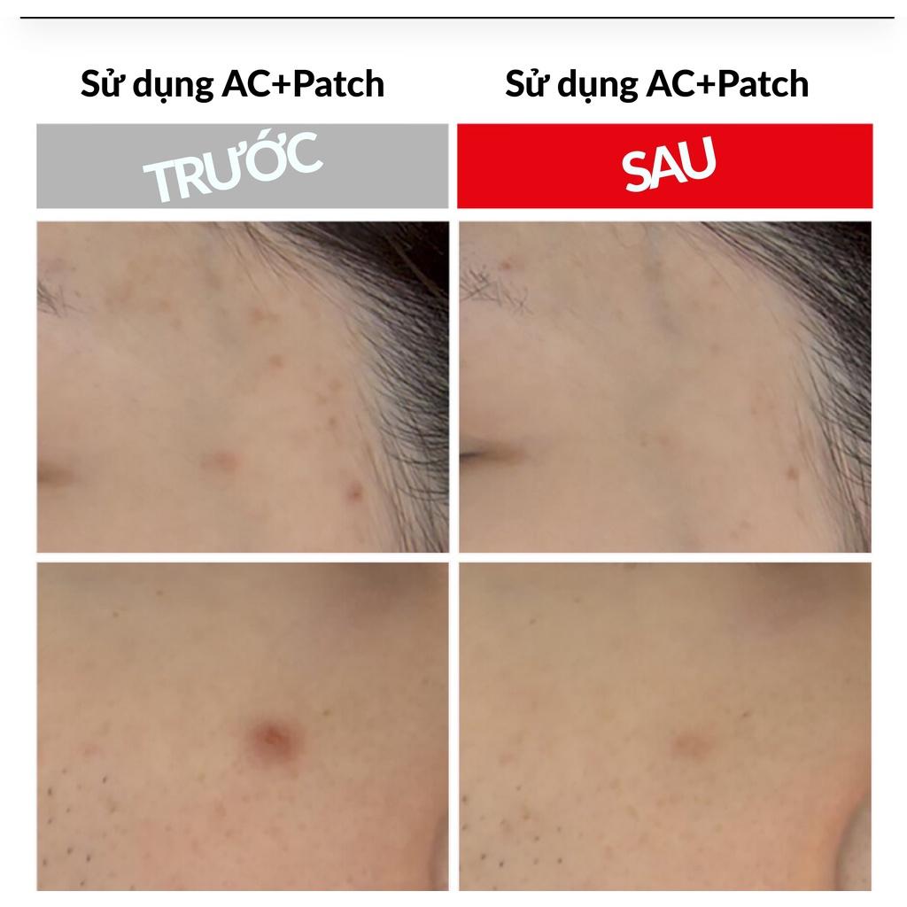 [Date 25/10/2024] Miếng dán mụn Hàn Quốc mỏng nhẹ trong suốt AC+ TROUBLE PATCH giải pháp cấp cứu cho da bị mụn {Có tem phụ nhập khẩu chính ngạch}