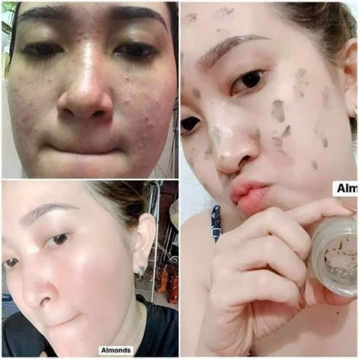 Melasma skin care- Kem dưỡng trắng da Cao đông y nám Almonds-  20g