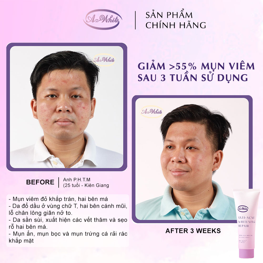 Tuýp Kem Ngừa Mụn &amp; Dưỡng Trắng Da A-White 7G