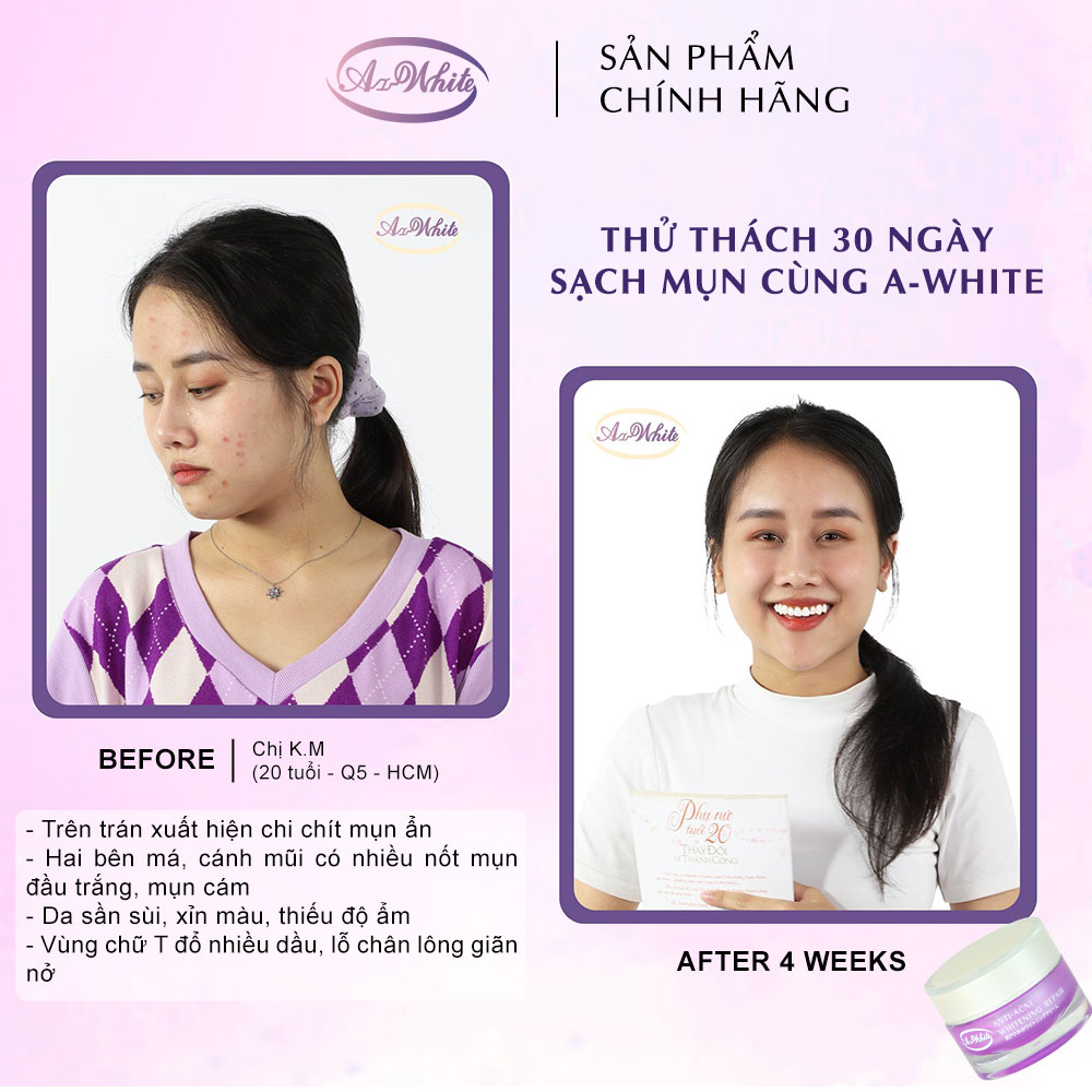 Kem Ngừa Mụn &amp; Dưỡng Trắng Da A-White 25G