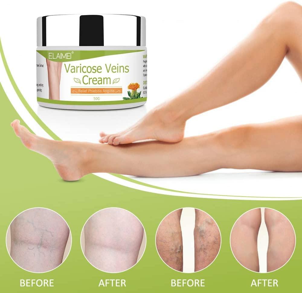 Kem tĩnh mạch giãn tĩnh mạch 50g Kem tĩnh mạch so với tĩnh mạch nhện, tĩnh mạch giãn tĩnh mạch và tĩnh mạch nhện, tĩnh mạch giãn, thuốc mỡ chăm sóc chân