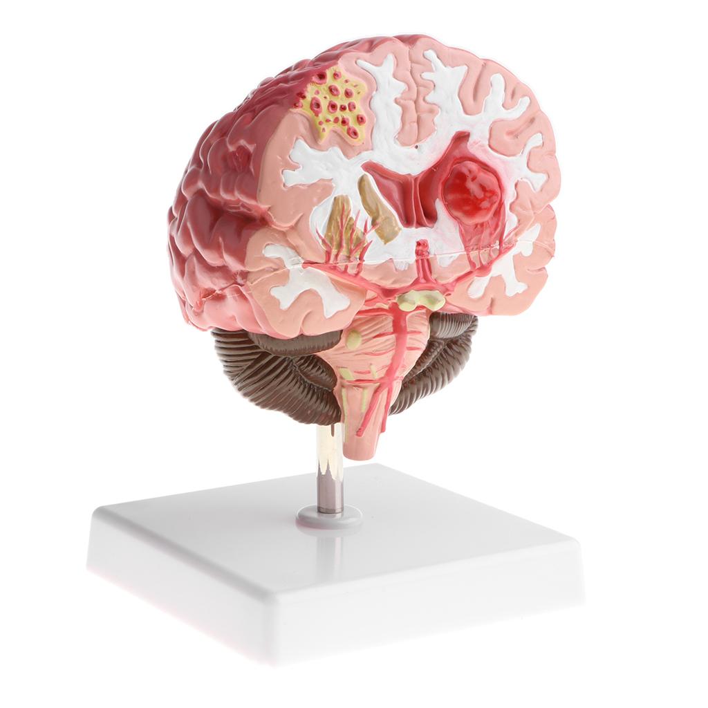 Anatomical Human Brain Disease Pathological Model Medical Teaching Tool Lab