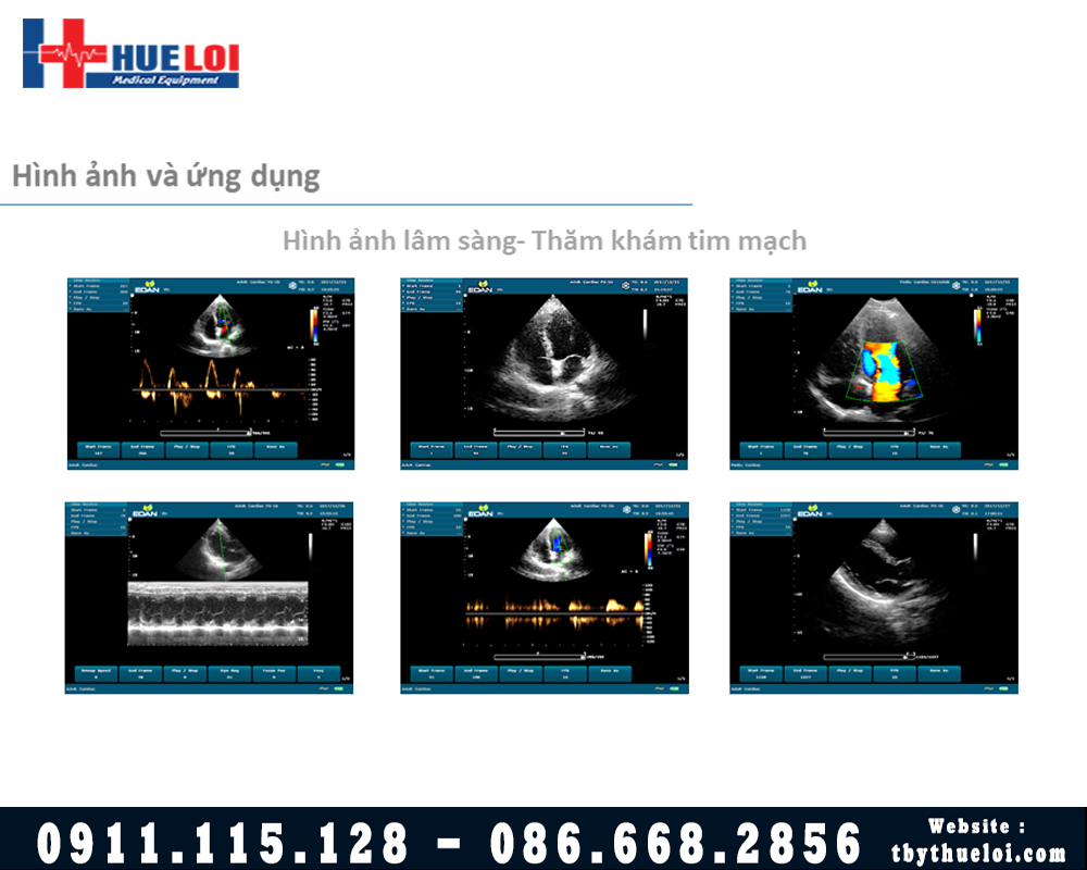 Máy Siêu Âm Xách Tay EDAN U60 - Hình Ảnh Sắc Nét Xứng Đáng Đầu Tư