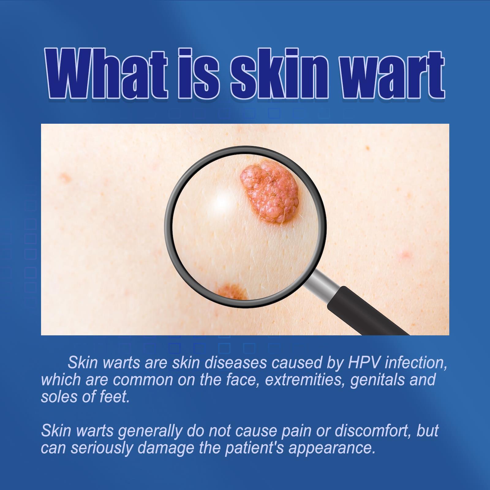 South Moon 30pcs/Box Mole Wart Remover Skin Tag Rubber Band Soften Keratin Painless Removal