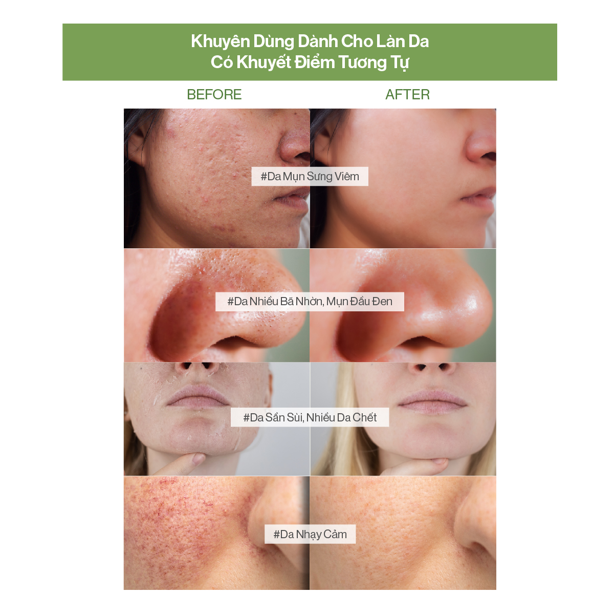 Sữa rửa mặt Khổ qua và Vegan BHA Gilaa Plant Serum giúp làm sạch da và giảm mụn