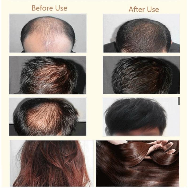 Tinh chất mọc tóc, giảm rụng L'Oreal Serioxyl Aminexil Scalp Advanced Pháp/TBN