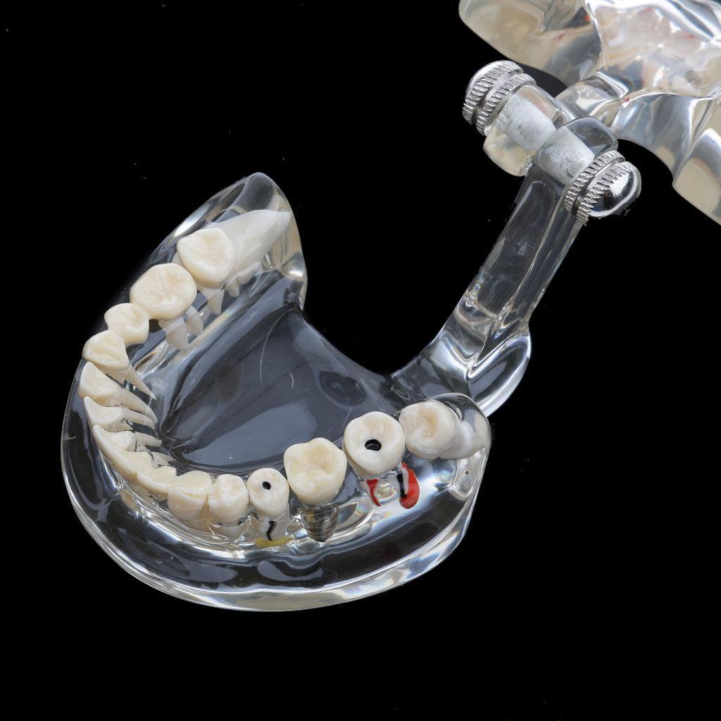 Dental Implant Disease Teeth Model Dentist Removable Tooth Model Tool Clear