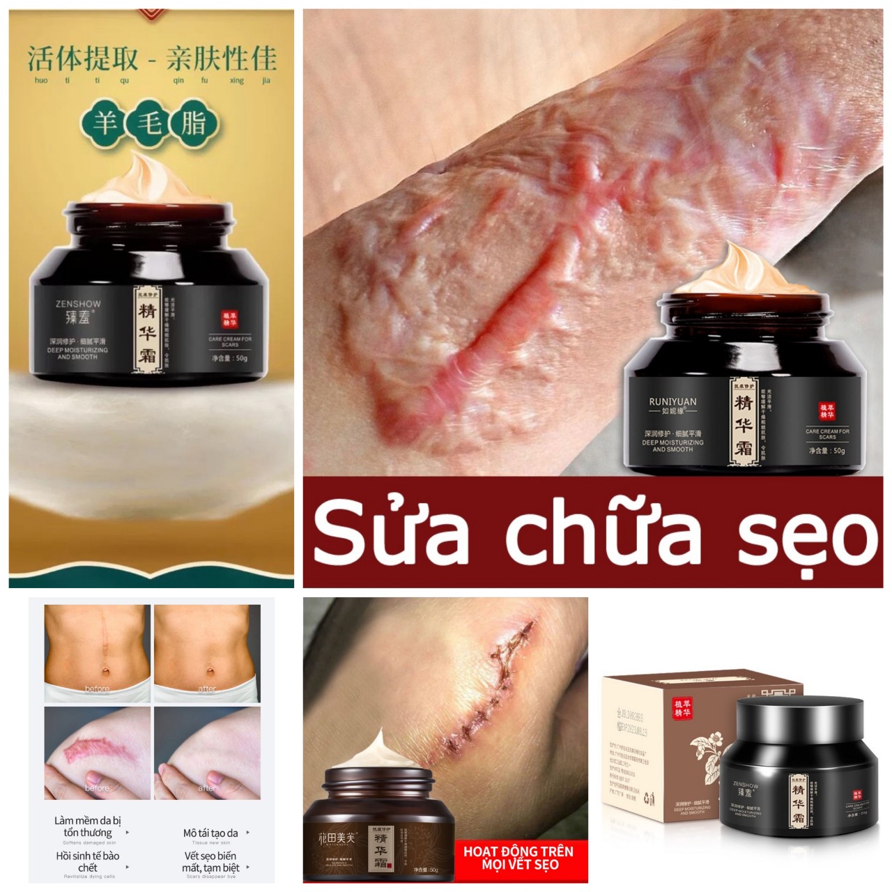 Kem xoá sẹo thâm lồi, bỏng, thủy đậu, rạn da sau sinh , vết thâm mặt cải thiện làn da sáng mịn hiệu quả loại tốt