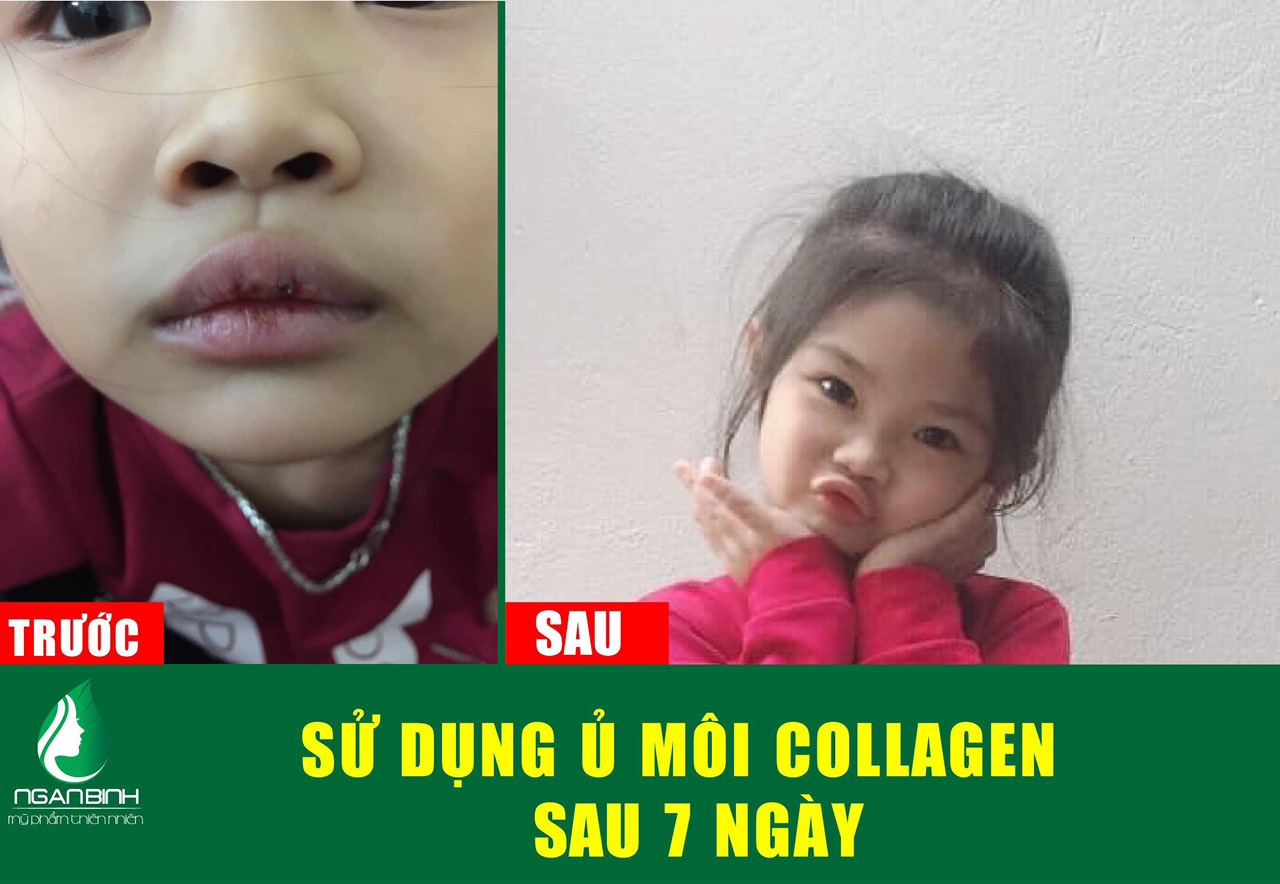 Ủ MÔI COLLAGEN