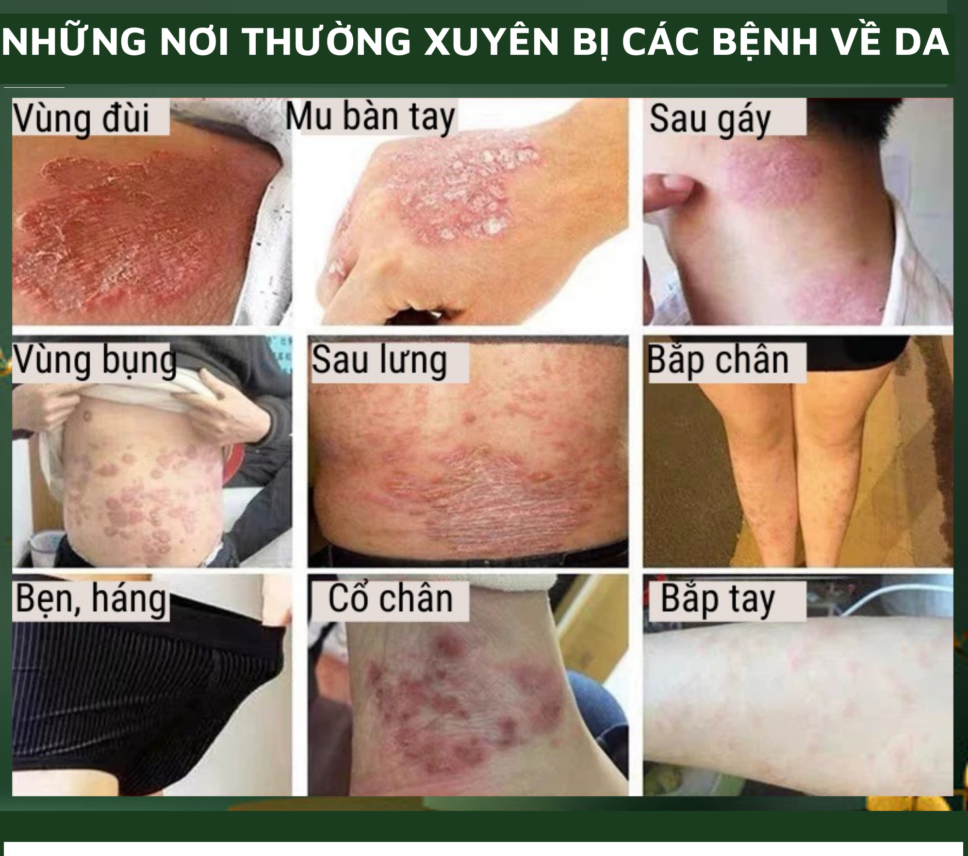 Kem dưỡng da, kháng khuẩn, chống ngứa, tinh chất thảo dược thiên nhiên, tặng kèm vòng tay Luminous