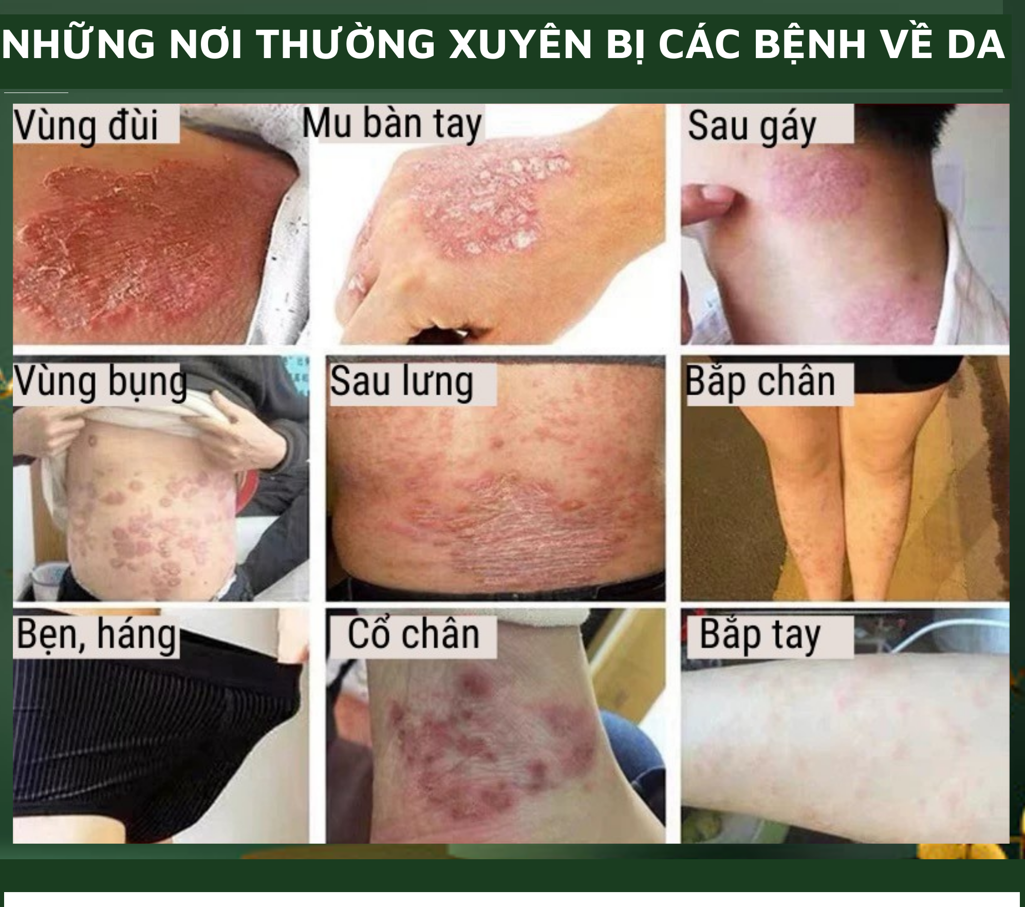 Kem hỗ trợ bôi vảy nến, ngứa do nấm, viêm da, tinh chất thảo dược thiên nhiên, tặng kèm vòng tay Luminous