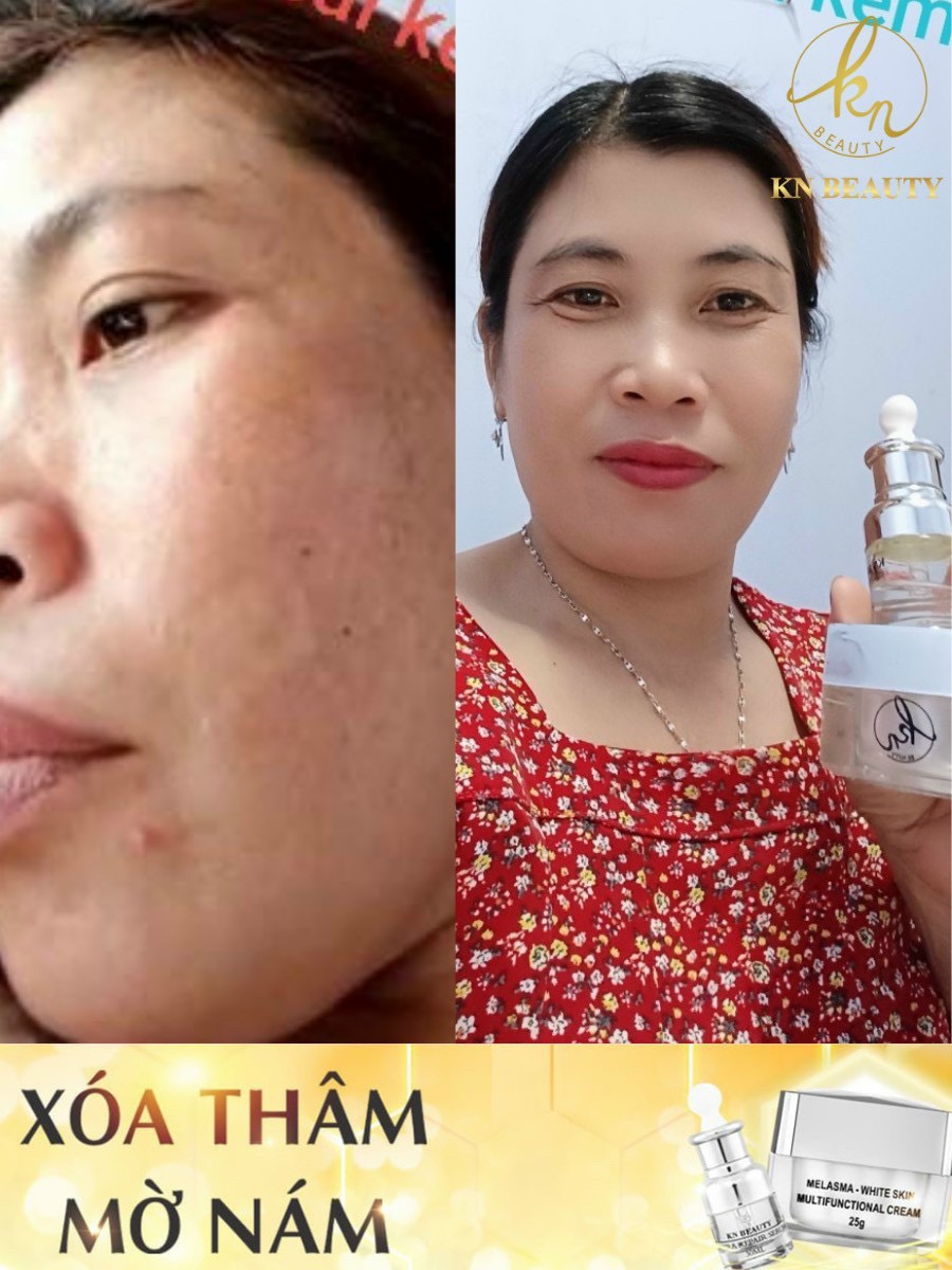 Bộ 4sp Trắng Da Ngừa Nám KN Beauty chuyên sâu:Kem dưỡng+Serum+Sữa rửa mặt+Tẩy tế bào chết