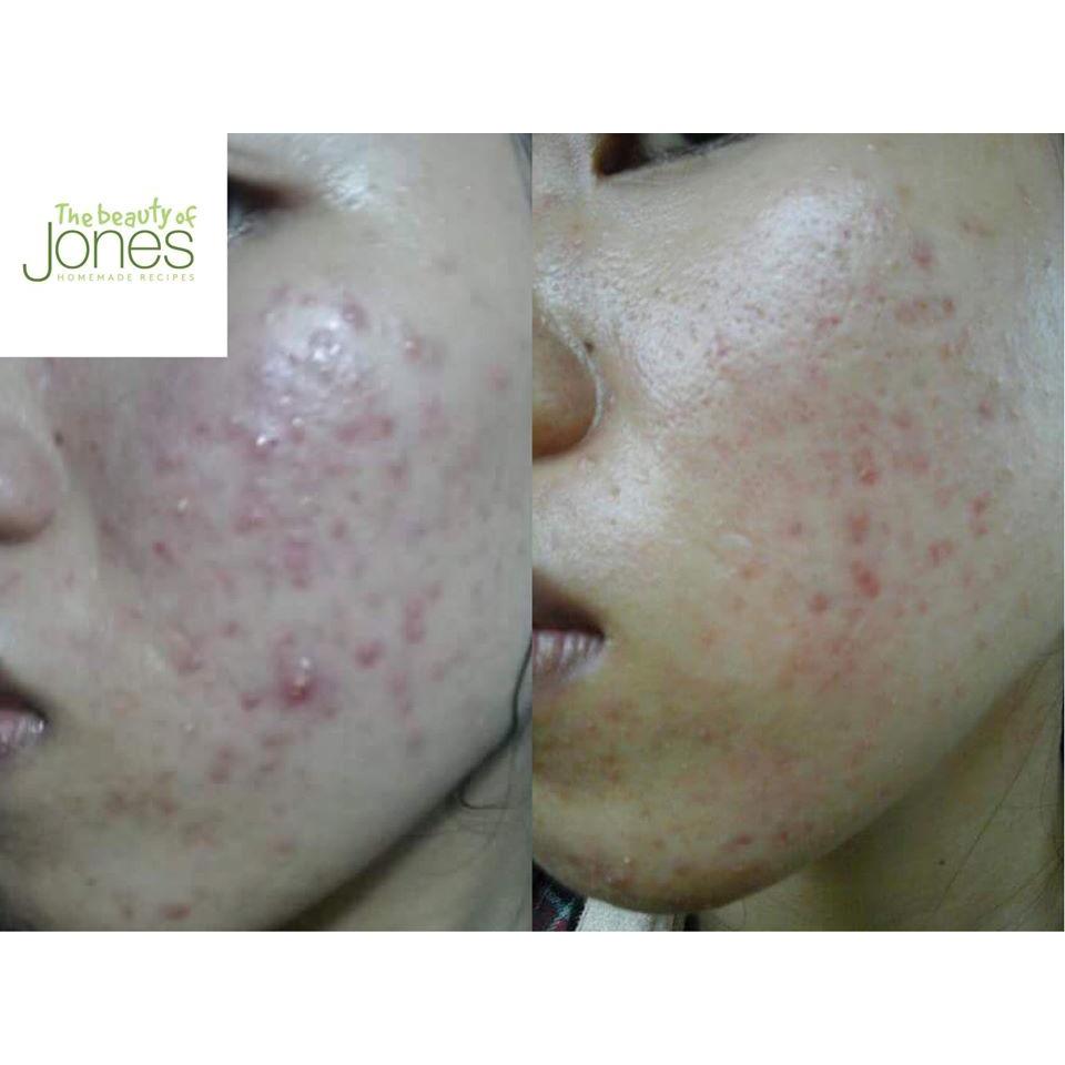 Combo 2 tuýp Sữa rửa mặt da mụn nhạy cảm từ trà xanh tảo biển The Beauty of Jones